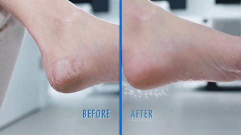 Electric Callus Remover with Vacuum Absorption